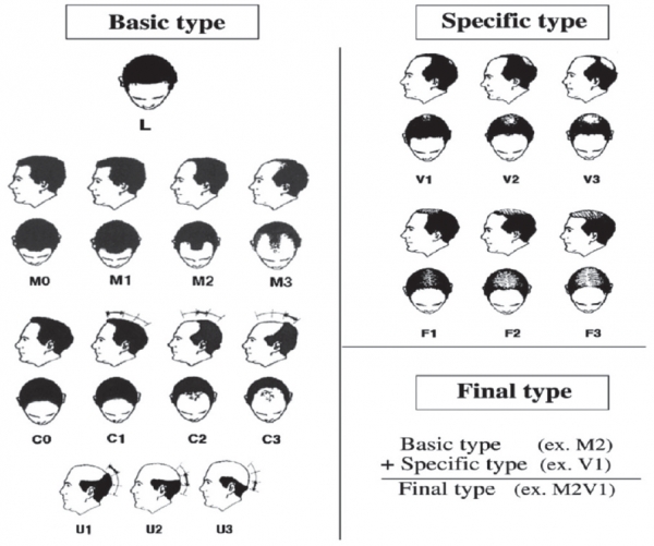그림 1. Basic And Specific Pattern(BASP)에 따른 안드로겐성 탈모의 분류.