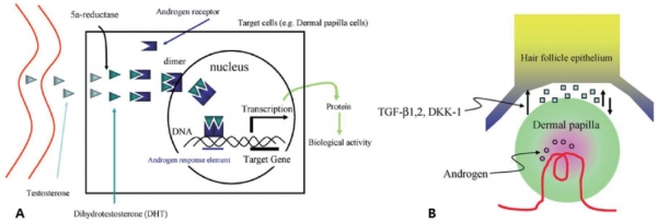 그림 2. 안드로겐성 탈모의 발생 기전 (Journal of Dermatological Science 2011;61:1–6).A: 안드로겐성 탈모에서 Testosterone, 5αreductase, DHT의 역할.B: Androgen 작용에 의한 Paracrine mediator의 역할 (TGFβ, DKK-1).