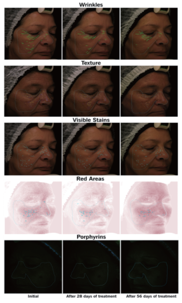 그림 5. Results on volunteers' facial parameters as shown by VISIA®